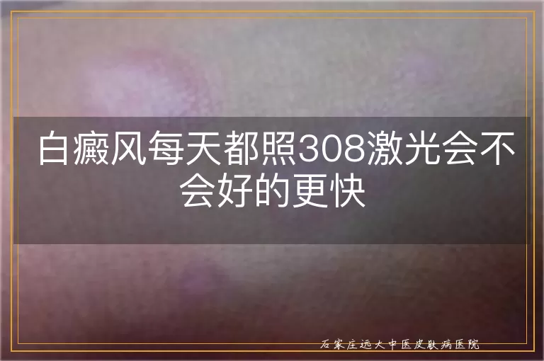 白癜风每天都照308激光会不会好的更快