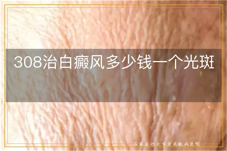 308治白癜风多少钱一个光斑