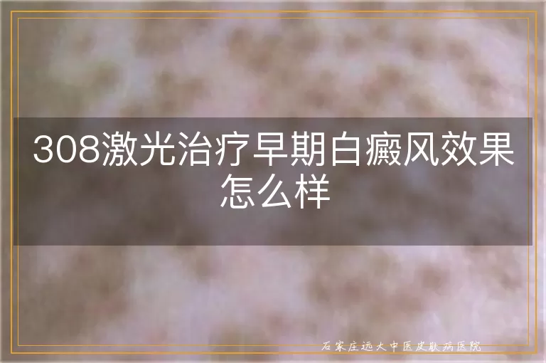 308激光治疗早期白癜风效果怎么样