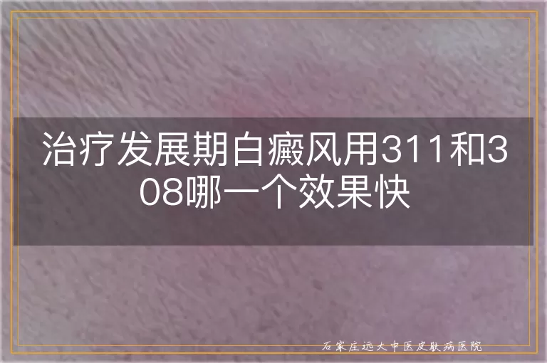 治疗发展期白癜风用311和308哪一个效果快