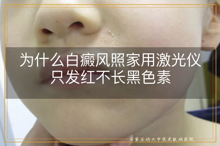 为什么白癜风照家用激光仪只发红不长黑色素