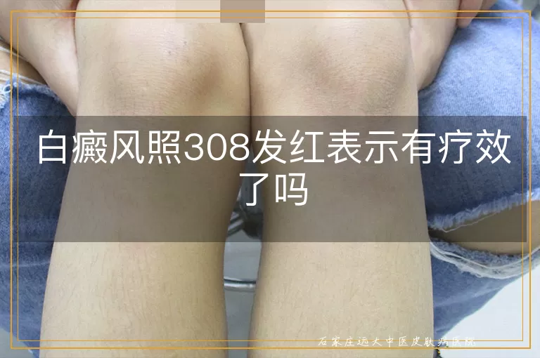 白癜风照308发红表示有疗效了吗