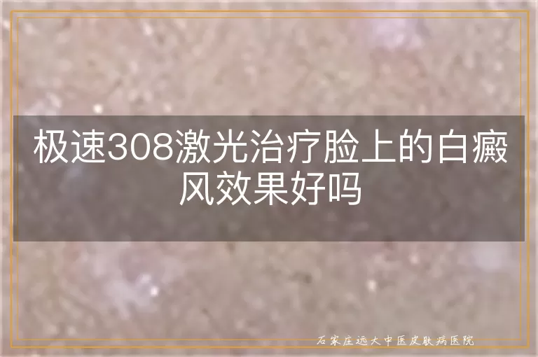 极速308激光治疗脸上的白癜风效果好吗