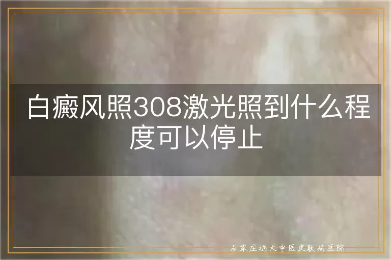 白癜风照308激光照到什么程度可以停止