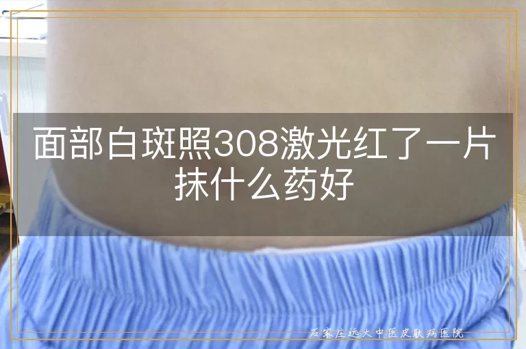 面部白斑照308激光红了一片抹什么药好