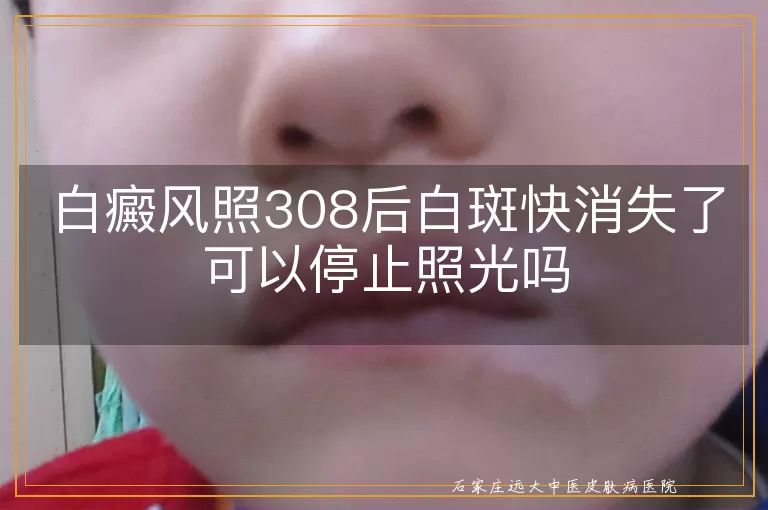 白癜风照308后白斑快消失了可以停止照光吗