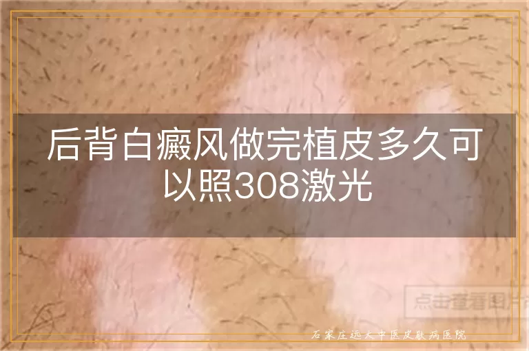 后背白癜风做完植皮多久可以照308激光