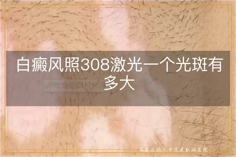 白癜风照308激光一个光斑有多大