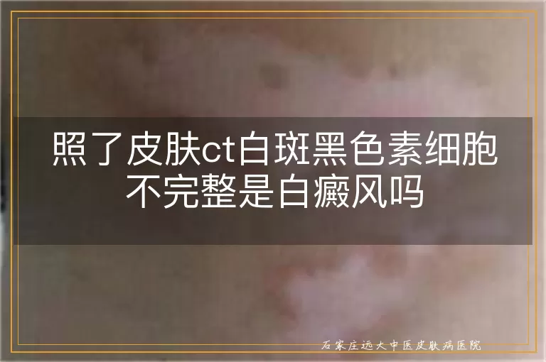 照了皮肤ct白斑黑色素细胞不完整是白癜风吗