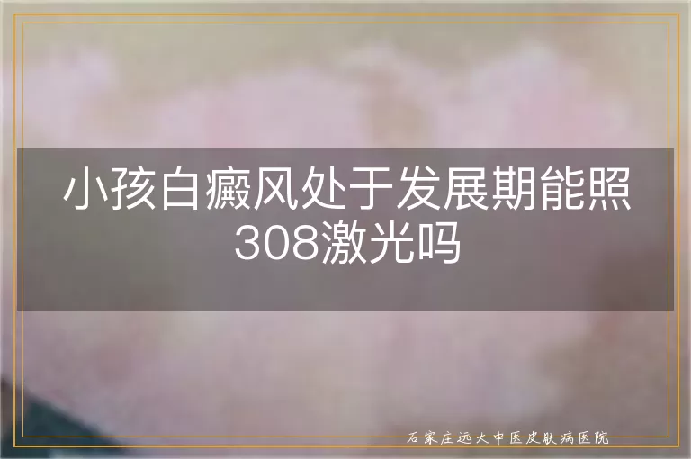 小孩白癜风处于发展期能照308激光吗