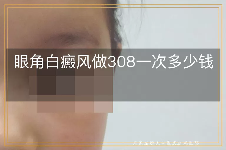 眼角白癜风做308一次多少钱