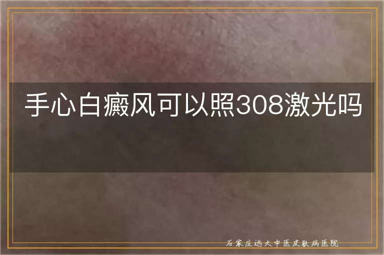 手心白癜风可以照308激光吗