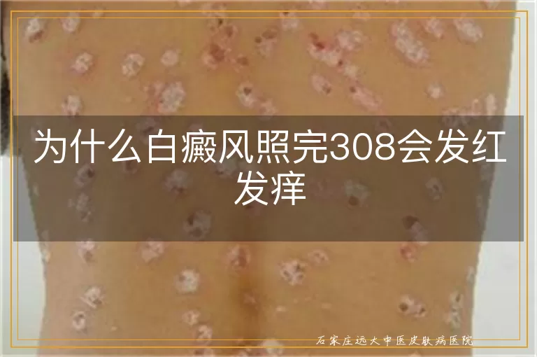 为什么白癜风照完308会发红发痒