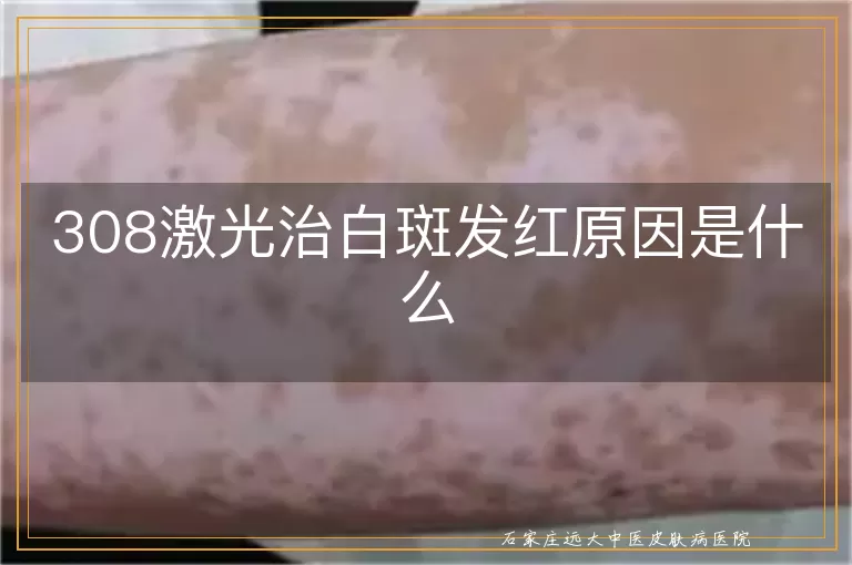 308激光治白斑发红原因是什么