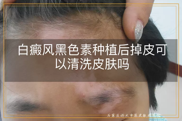 白癜风黑色素种植后掉皮可以清洗皮肤吗