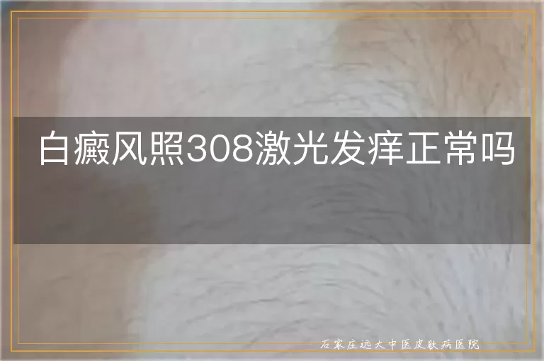 白癜风照308激光发痒正常吗