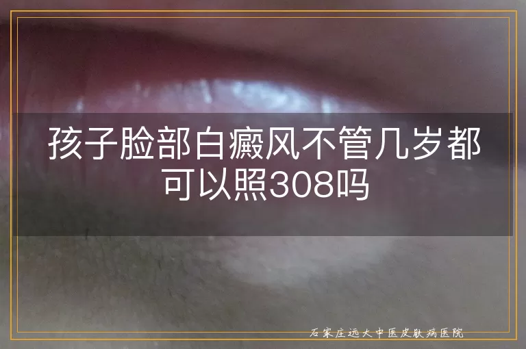 孩子脸部白癜风不管几岁都可以照308吗