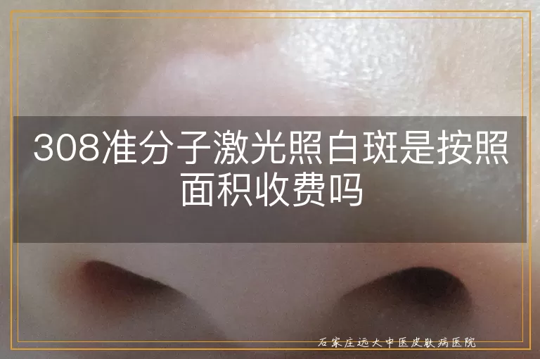 308准分子激光照白斑是按照面积收费吗