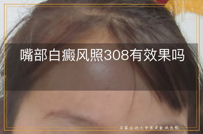 嘴部白癜风照308有效果吗