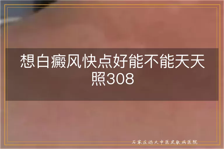 想白癜风快点好能不能天天照308