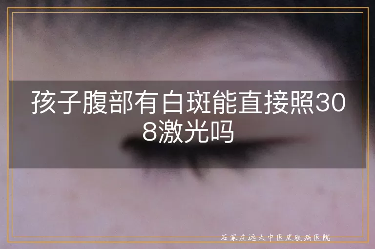 孩子腹部有白斑能直接照308激光吗