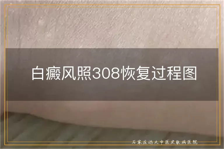 白癜风照308恢复过程图
