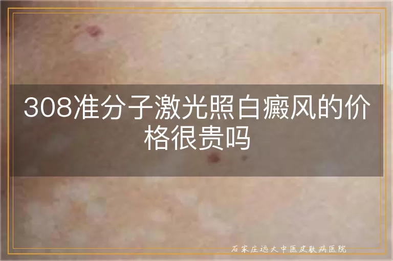 308准分子激光照白癜风的价格很贵吗