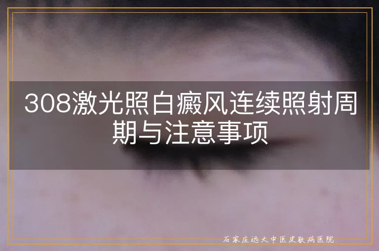 308激光照白癜风连续照射周期与注意事项