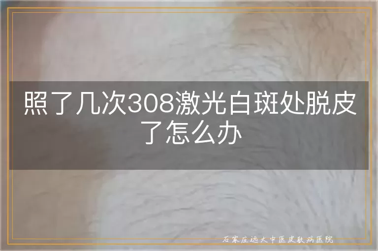照了几次308激光白斑处脱皮了怎么办