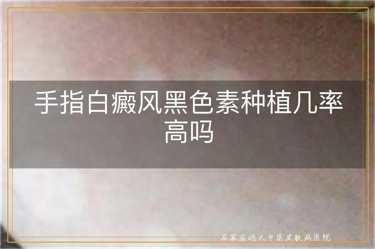 手指白癜风黑色素种植几率高吗