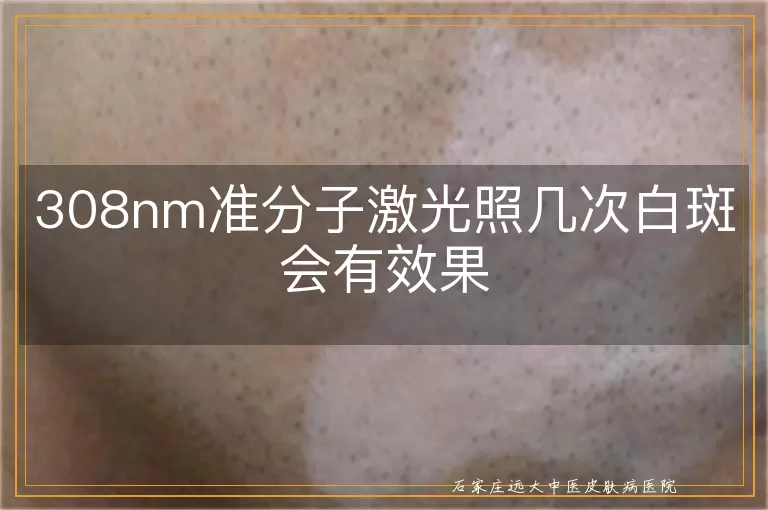 308nm准分子激光照几次白斑会有效果