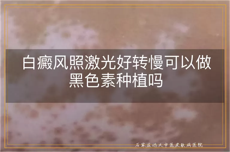 白癜风照激光好转慢可以做黑色素种植吗