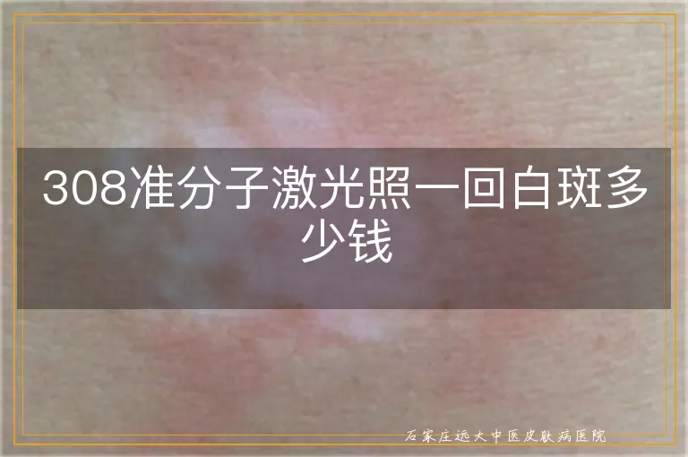 308准分子激光照一回白斑多少钱