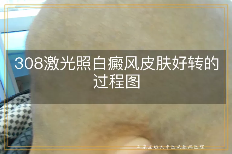 308激光照白癜风皮肤好转的过程图