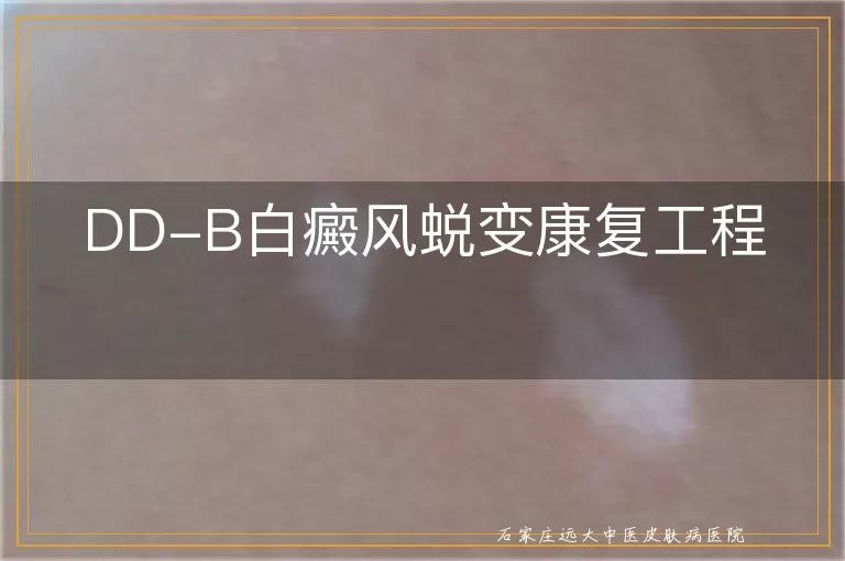 DD-B白癜风蜕变康复工程