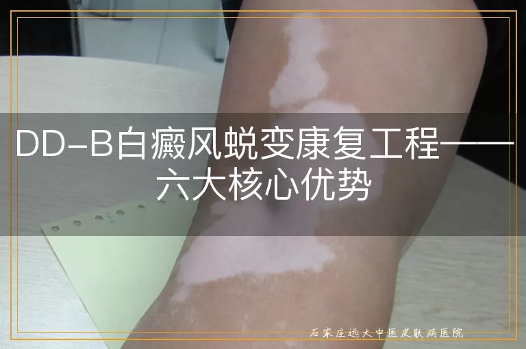 DD-B白癜风蜕变康复工程——六大核心优势