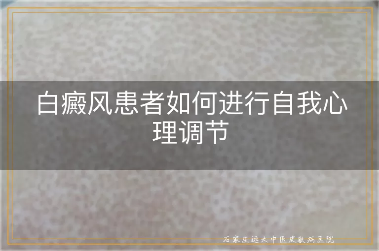 白癜风患者如何进行自我心理调节
