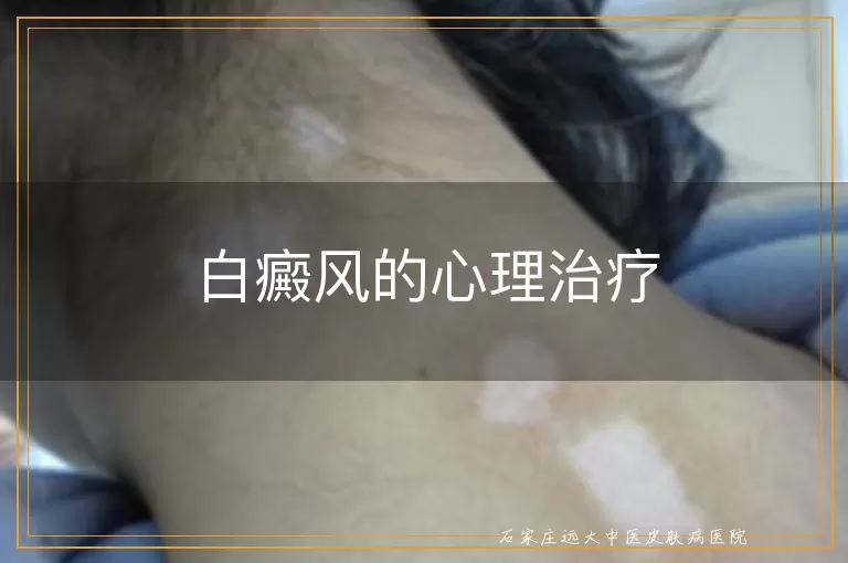 白癜风的心理治疗