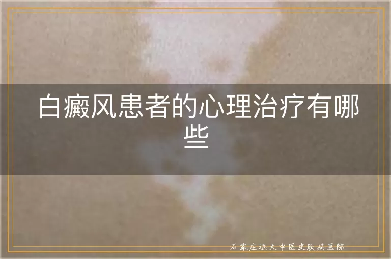 白癜风患者的心理治疗有哪些