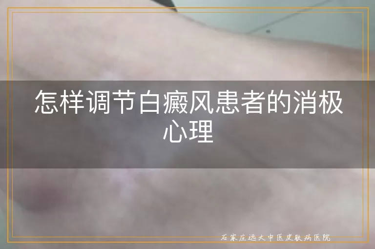 怎样调节白癜风患者的消极心理