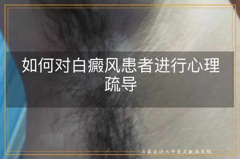 如何对白癜风患者进行心理疏导