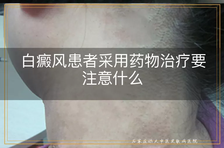 白癜风患者采用药物治疗要注意什么