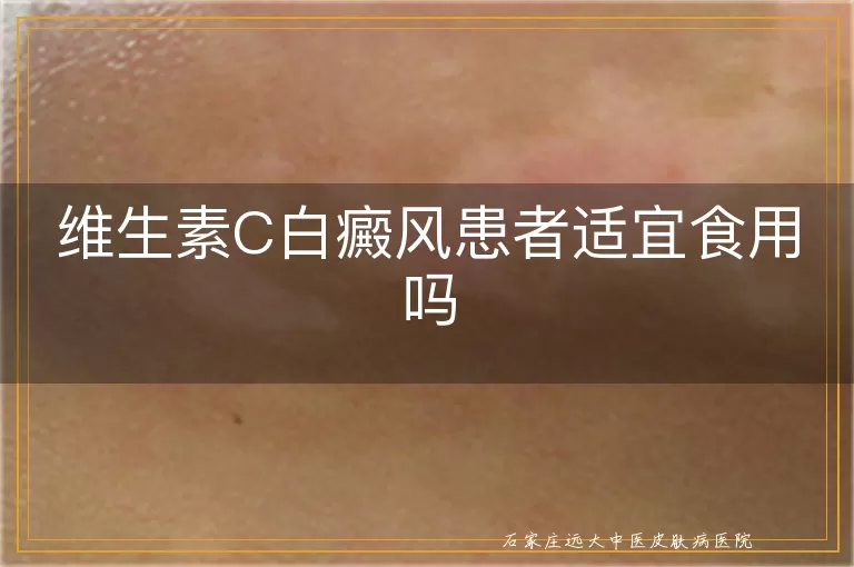维生素C白癜风患者适宜食用吗