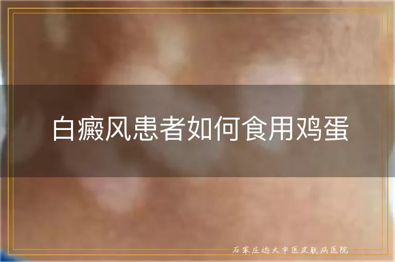 白癜风患者如何食用鸡蛋