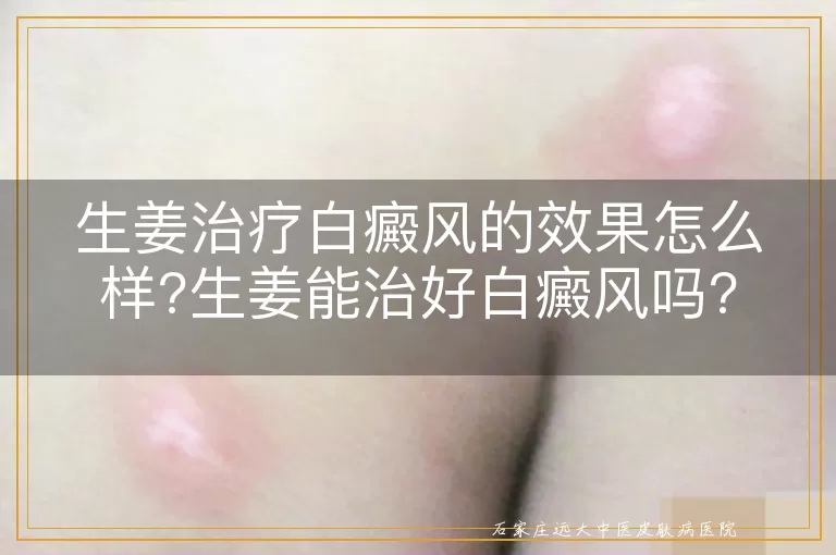 生姜治疗白癜风的效果怎么样?生姜能治好白癜风吗?