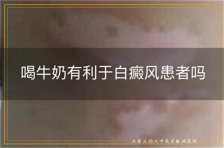 喝牛奶有利于白癜风患者吗