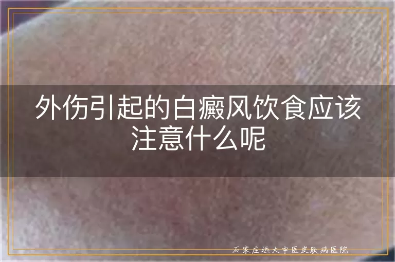 外伤引起的白癜风饮食应该注意什么呢