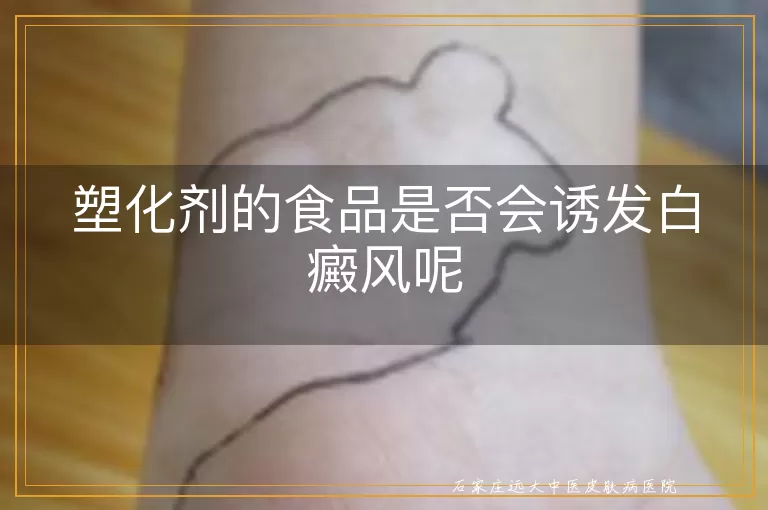 塑化剂的食品是否会诱发白癜风呢