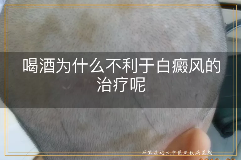 喝酒为什么不利于白癜风的治疗呢