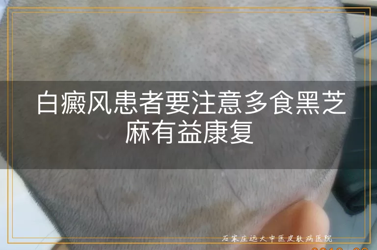 白癜风患者要注意多食黑芝麻有益康复